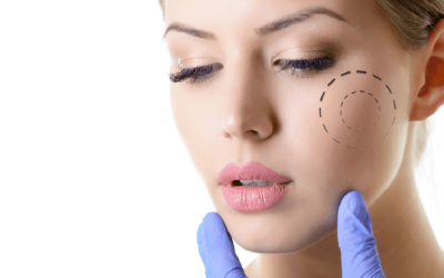 Bichectomia: a cirurgia de bochecha