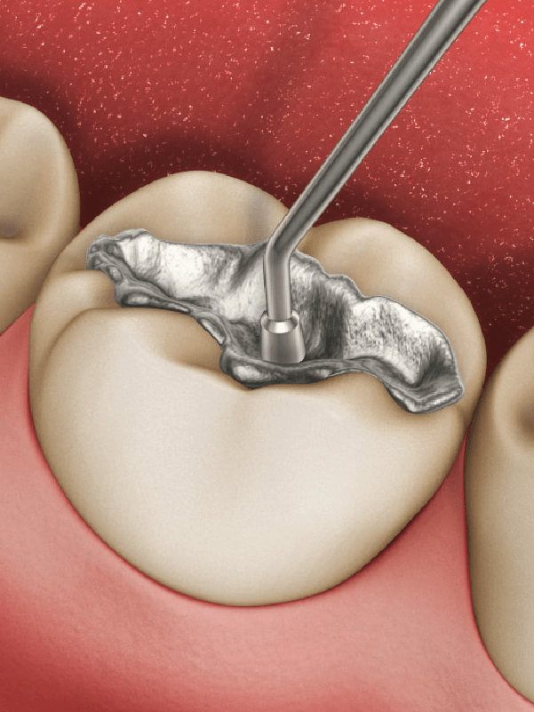 Restaurações - restauração dentária Restaurações - restauração dentária