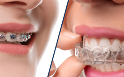 Invisalign: saiba mais sobre o aparelho transparente inovador