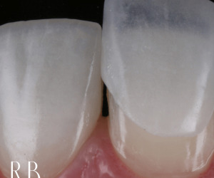 Lente de porcelana dental: o que é isso?