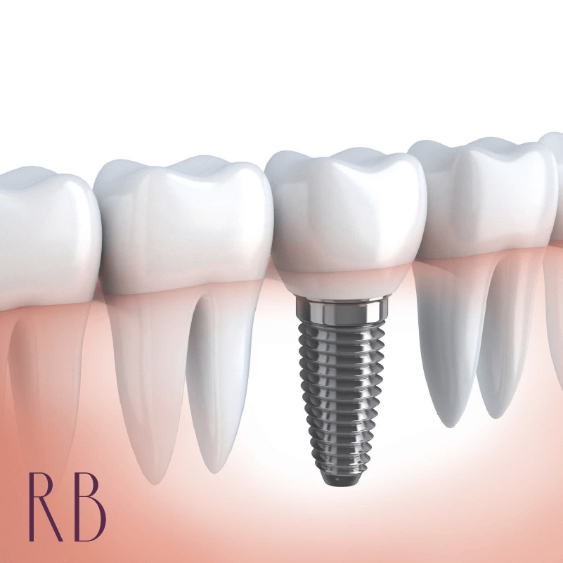 implante de dente