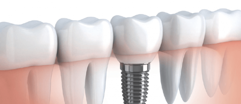 Implantodontia Tudo O Que Voc Precisa Saber Sobre Implante