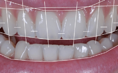 Planejamento Digital do Sorriso (Digital Smile Design)