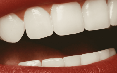 Clareamento dental: o que é, quando e por que fazer