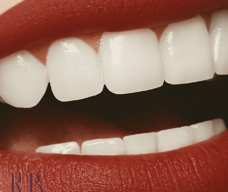 Clareamento dental: o que é, quando e por que fazer