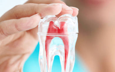 Endodontia: tratamento de canal (canal dentário)