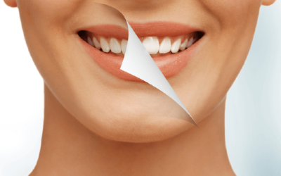 Reabilitação oral: tratamento de canal, de gengiva e implantes