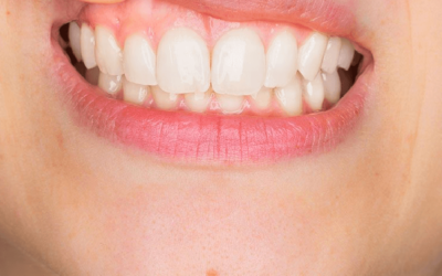 Periodontia: tire suas dúvidas sobre Gengivite