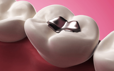 Restauração Dentária: transforme seu sorriso!