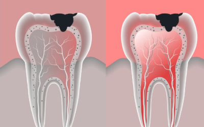 Endodontia – tira suas dúvidas sobre o tratamento de canal