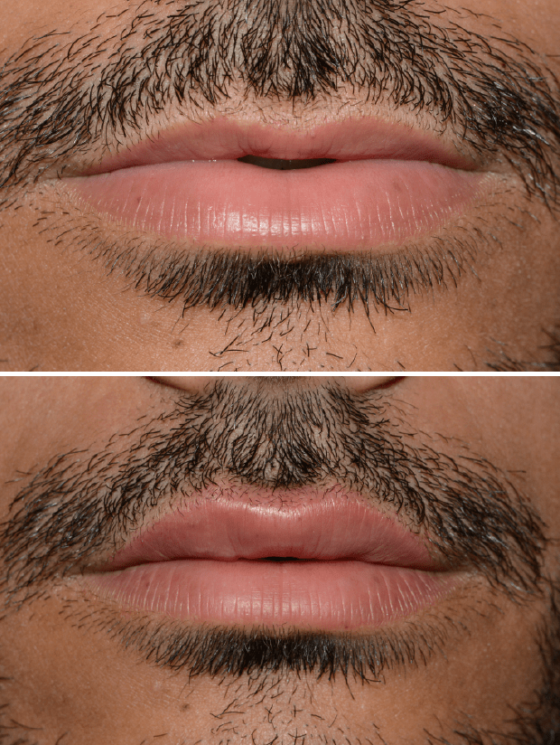 Preenchimento facial com ácido hialurônico Preenchimento facial com ácido hialurônico