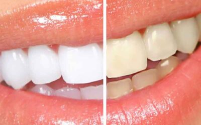 Mitos e verdades sobre o clareamento dental