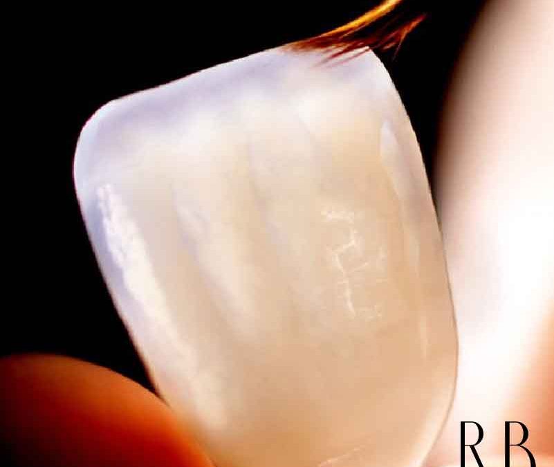 O que são lentes de contato dental e facetas de porcelana?