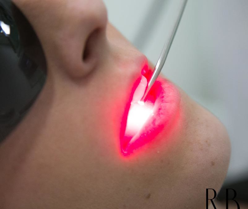 Benefícios da Laserterapia na odontologia