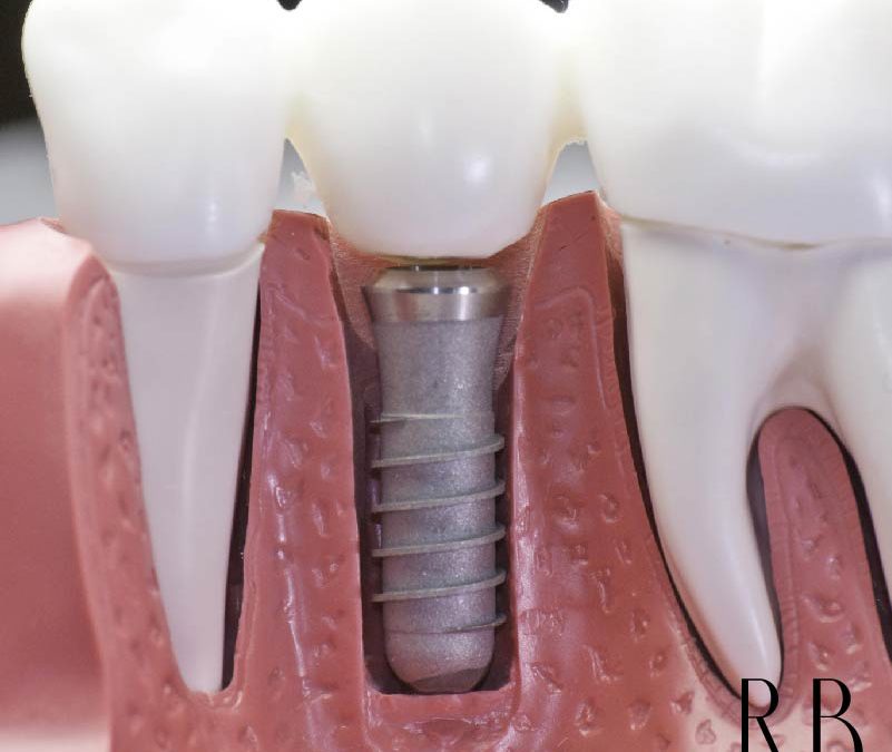Implante dentário – o que é e quais tipos existem