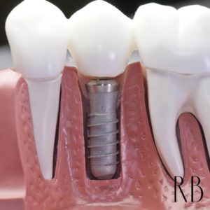 Implante dentário – o que é e quais tipos existem