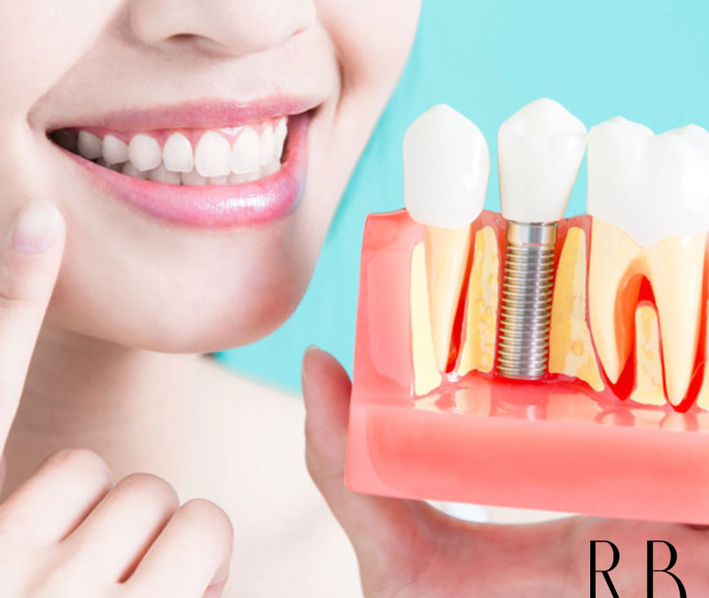 Reabilitação oral: tratamento de canal, de gengiva e implantes