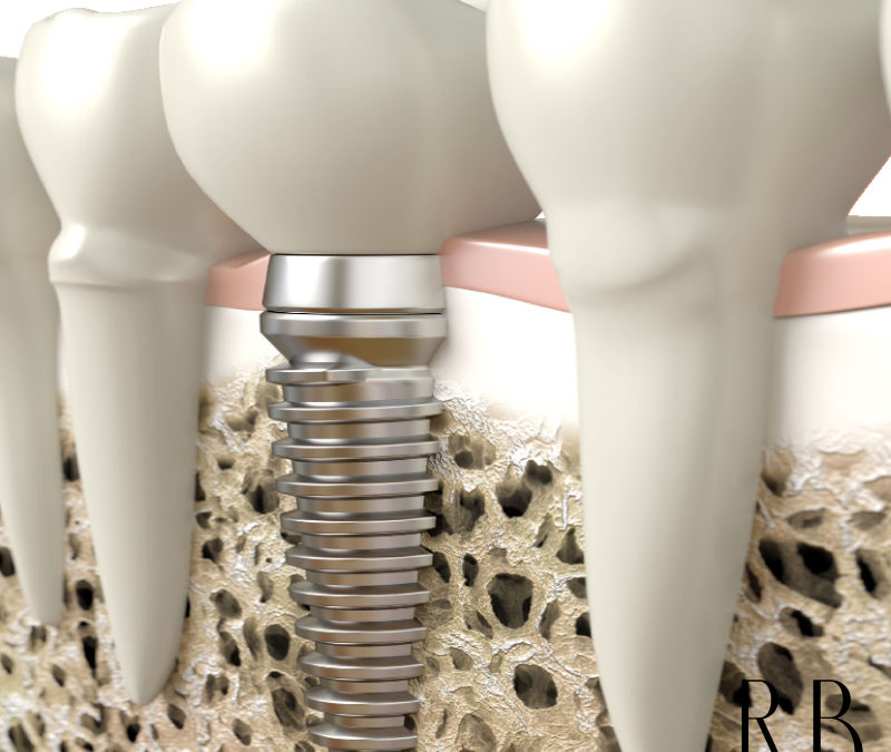 Dentista BH: cuidados pós-cirúrgico do implante dentário