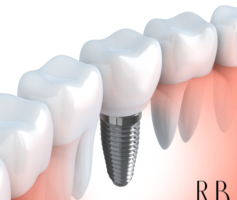 Implante dentário – Tire suas dúvidas
