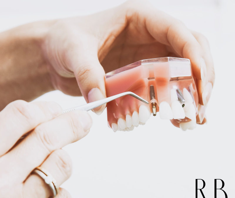 Implante dentário – Tire suas dúvidas – Parte 2
