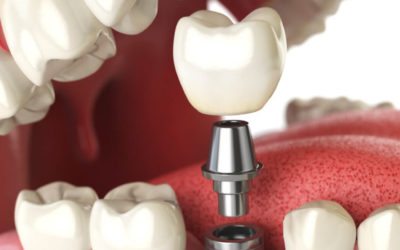 Clínica de Implantes – Implante Dentário e Prótese Dentária