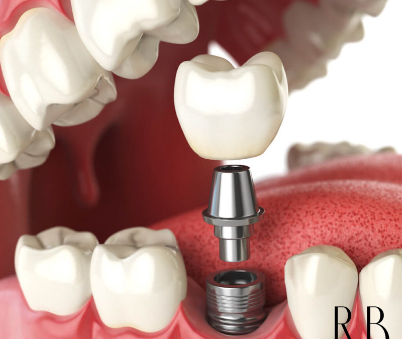 Clínica de Implantes – Implante Dentário e Prótese Dentária