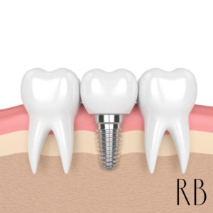 Implantes Dentários em BH – Indicações