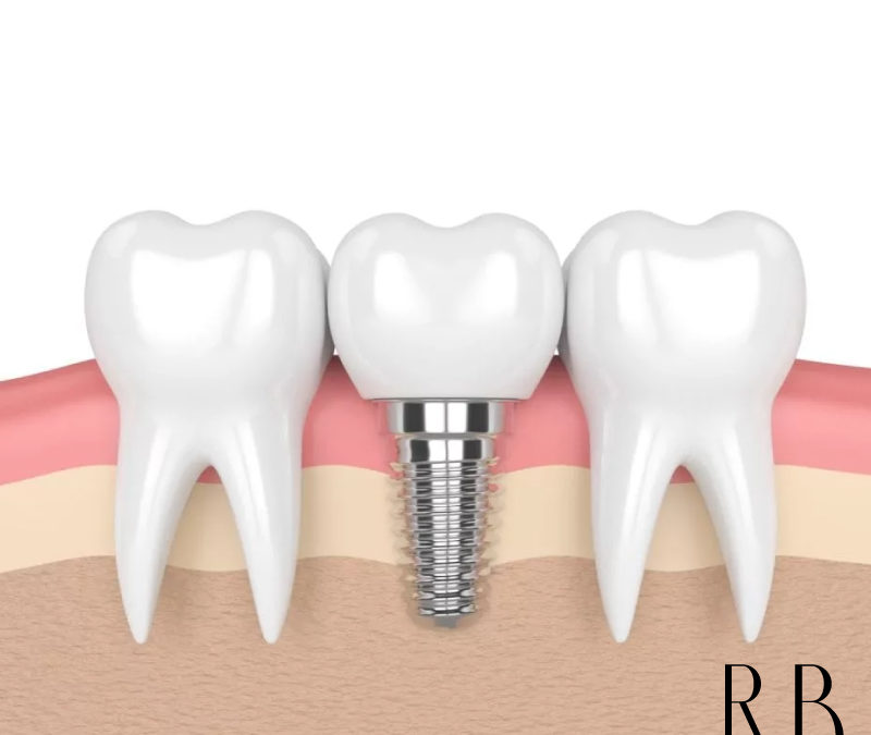 Implantes Dentários em BH – Indicações