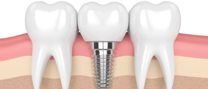 implantes-dentários-em-BH