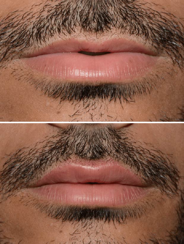 Preenchimento facial com ácido hialurônico Preenchimento facial com ácido hialurônico