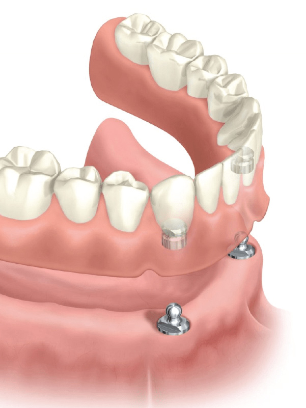 Prótese dentária fixa e prótese dentária móvel Prótese dentária fixa e prótese dentária móvel