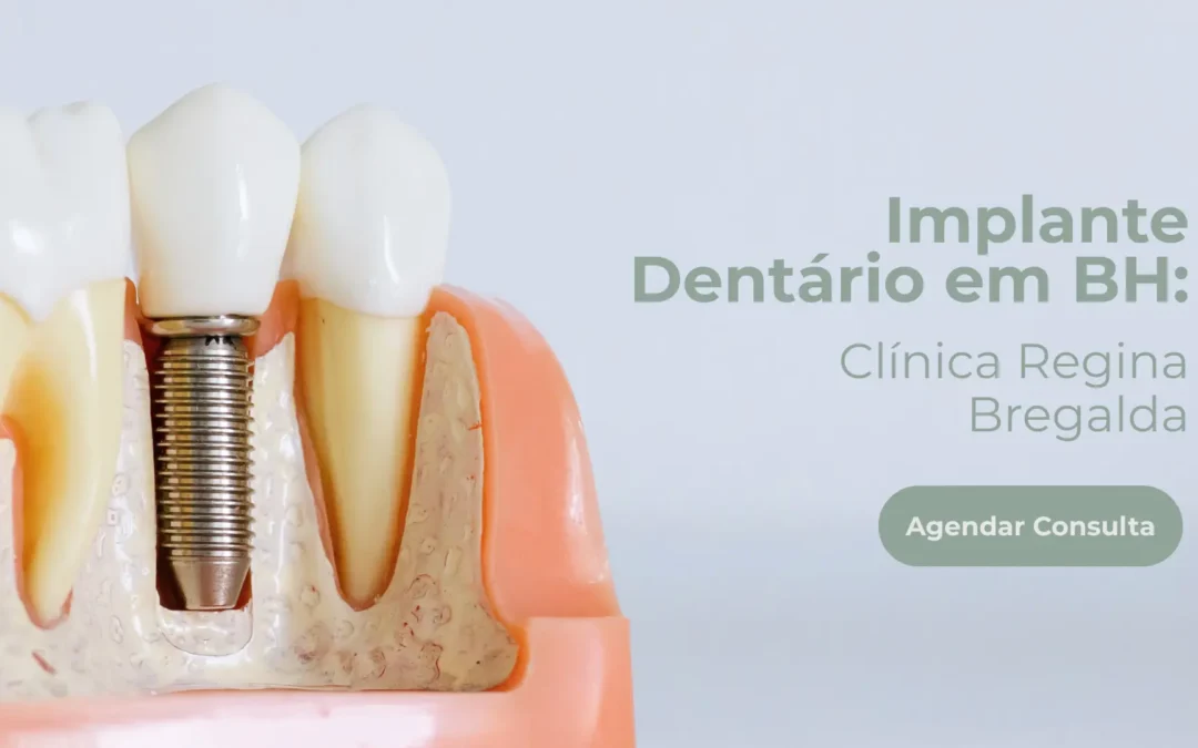 Implante dentário em BH: cuidados e indicações
