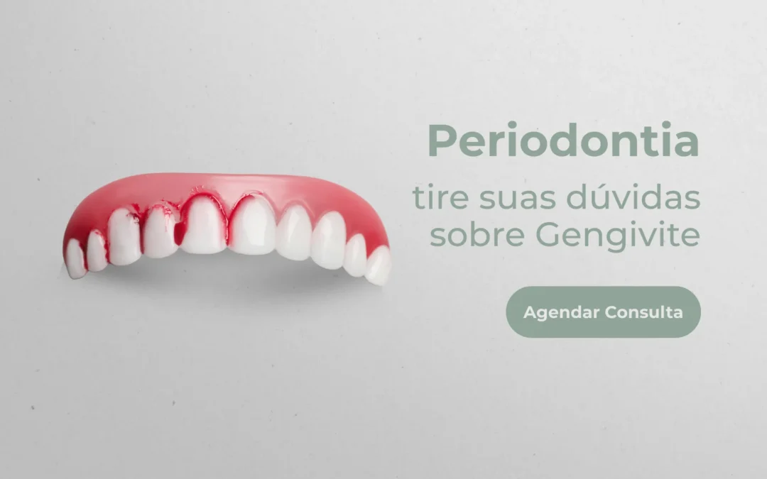 Periodontia: tire suas dúvidas sobre Gengivite