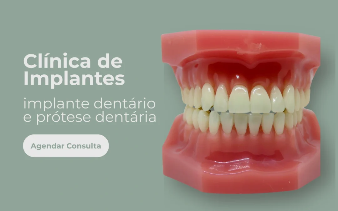Clínica de Implantes – Implante Dentário e Prótese Dentária