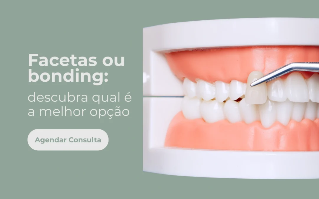 Facetas ou bonding: qual opção dura mais nos dentes?