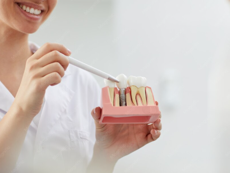 implante dentário em BH