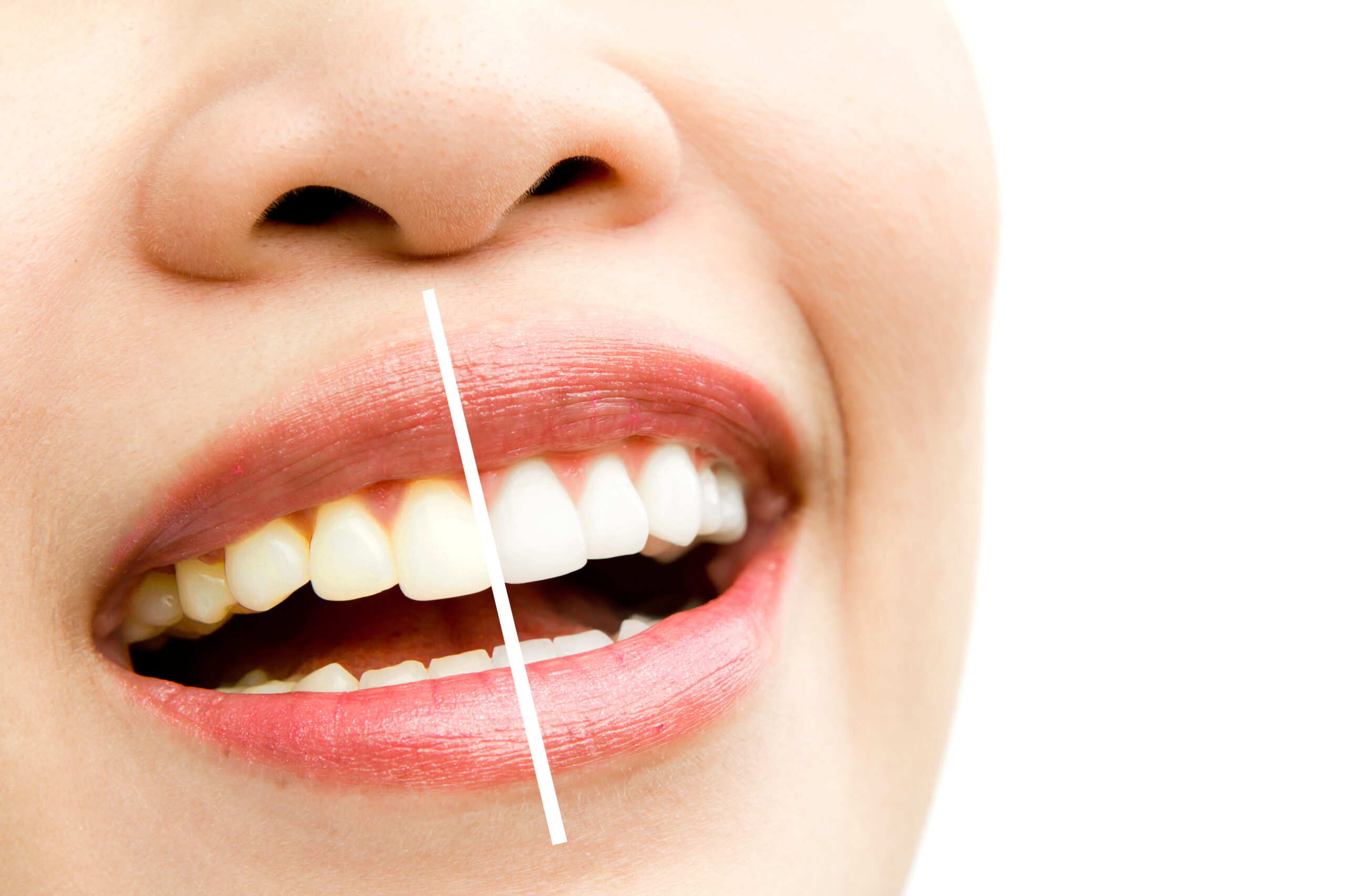 Clareamento dental enfraquece os dentes Mitos e verdades