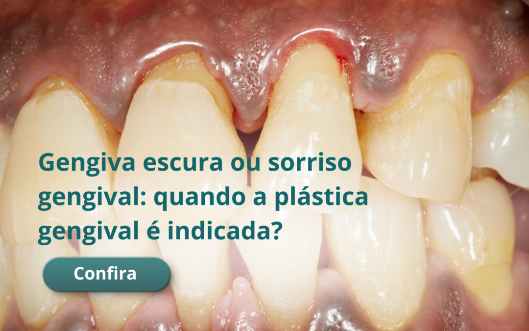 Gengiva escura ou sorriso gengival: quando a plástica gengival é indicada?