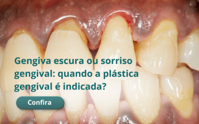 Gengiva escura ou sorriso gengival: quando a plástica gengival é indicada?