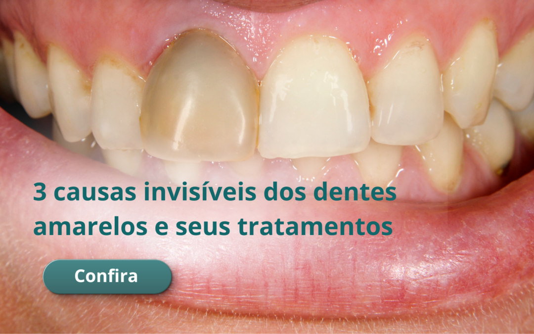 3 causas invisíveis dos dentes amarelos e seus tratamentos