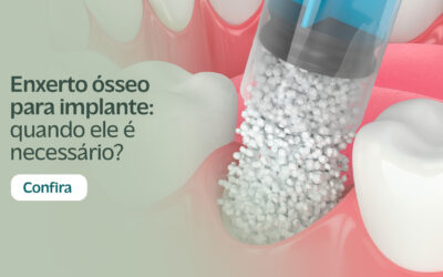 Enxerto ósseo para implante: quando ele é necessário?