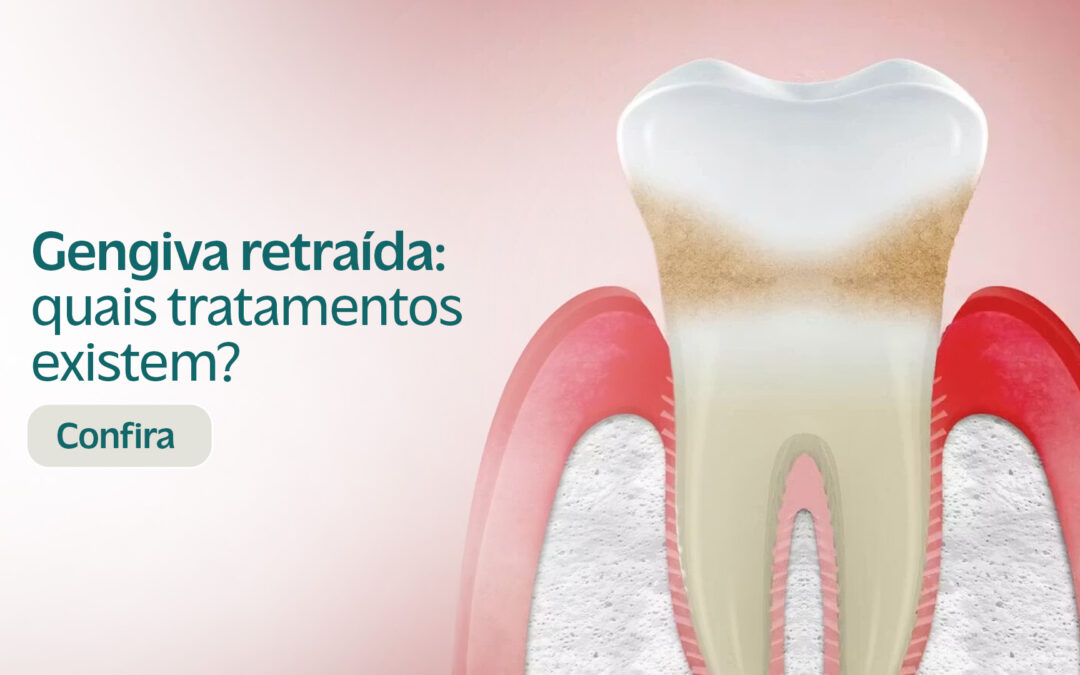 Gengiva retraída: quais tratamentos existem?