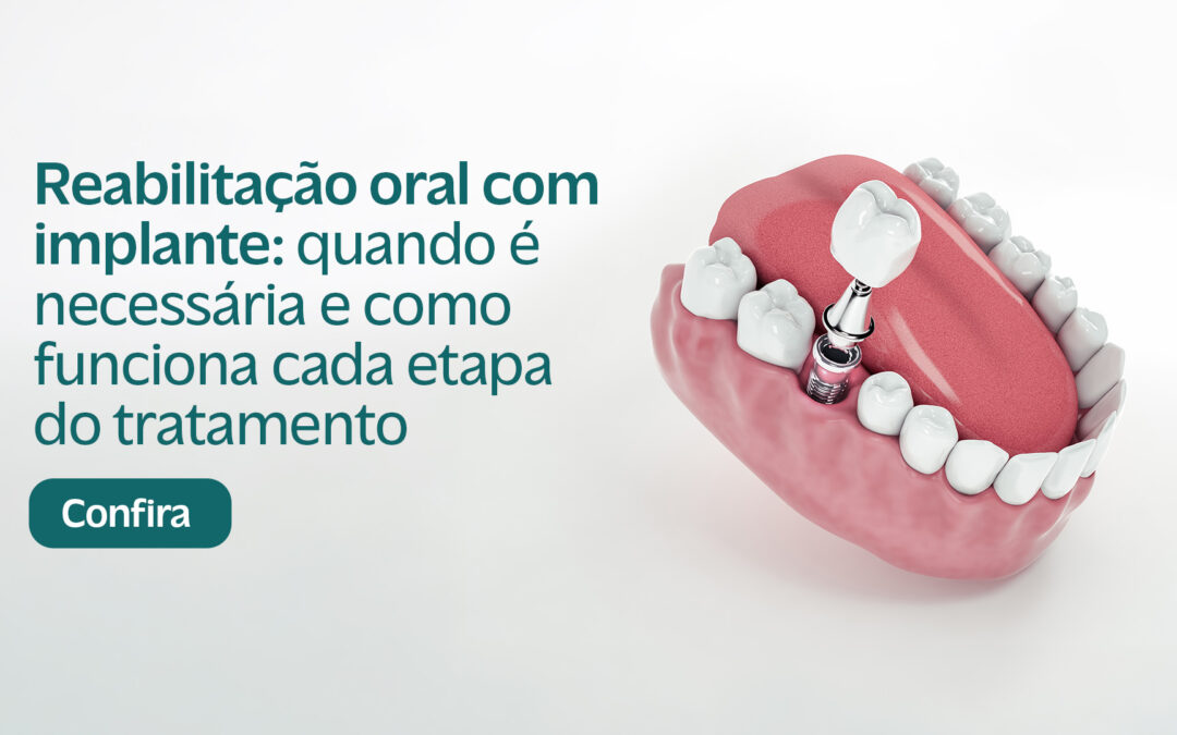 Reabilitação oral com implante: quando é necessária e como funciona cada etapa do tratamento